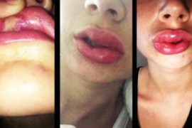 Reports Of Illegal Teeth Whitening Procedures Spike To 26%  