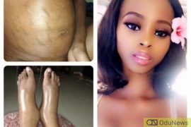 Mide with Sickle Cell