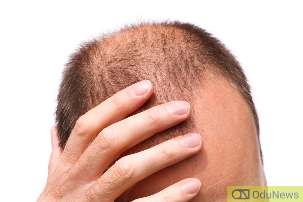 Scientists Identify Hair Loss Regulator Protein; Could Be Reversible  