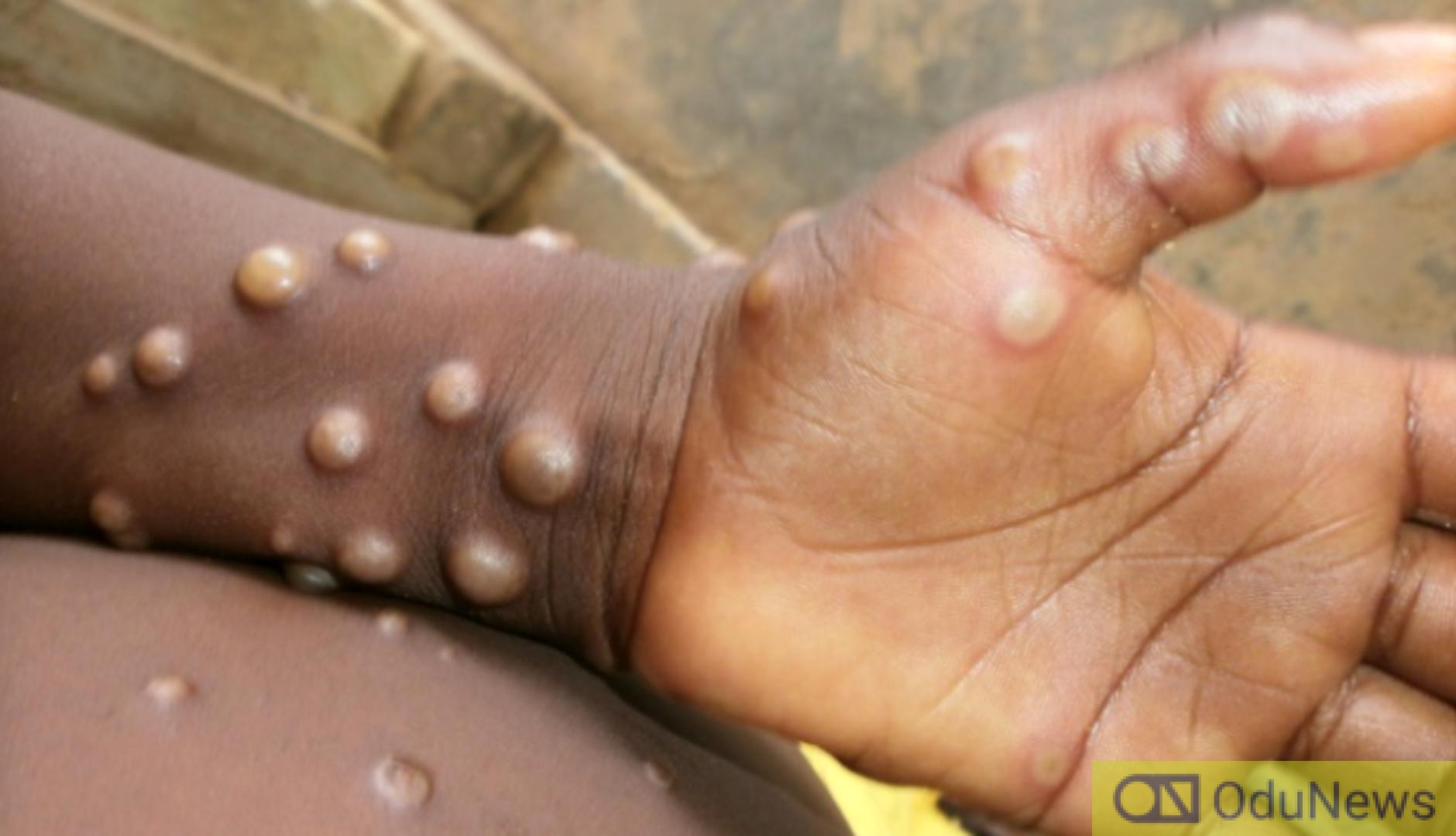 Monkeypox: Nigerian Man Tests Positive In India  